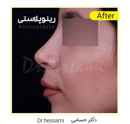 تجميل الأنف في إيران