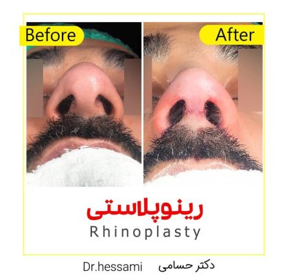 تجميل الأنف في إيران