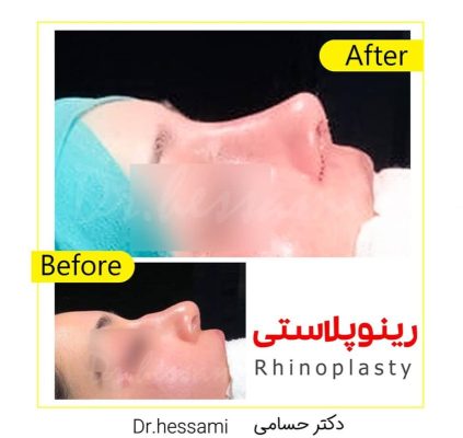 تجميل الأنف في إيران