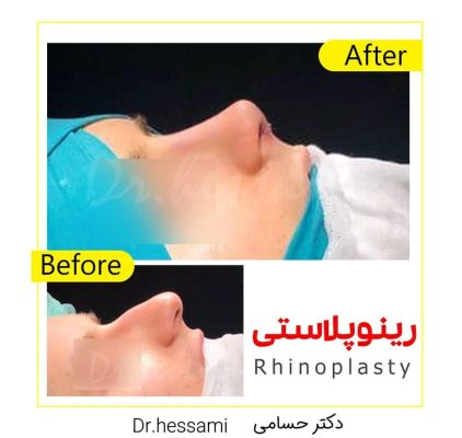 تجميل الأنف في إيران