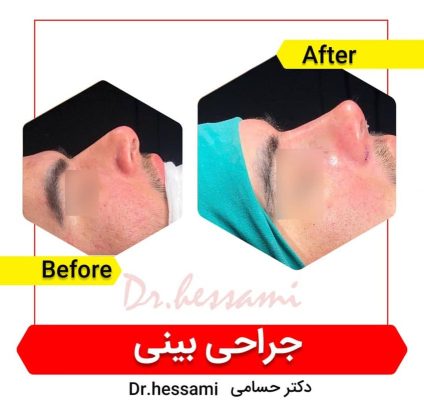 تجميل الأنف في إيران