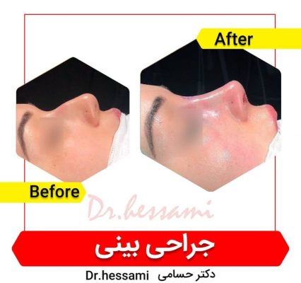 تجميل الأنف في إيران