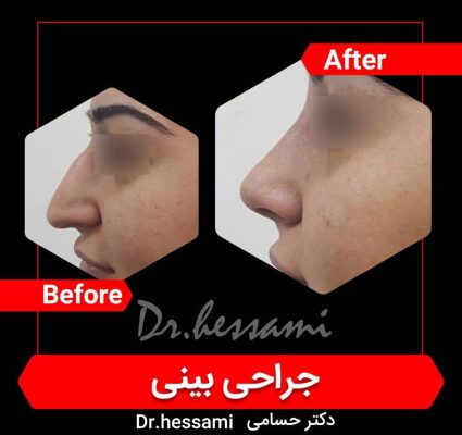 تجميل الأنف في إيران