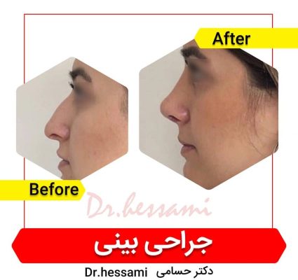 تجميل الأنف في إيران