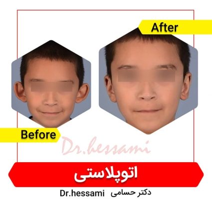 جراحة تجميل الأذن في إيران