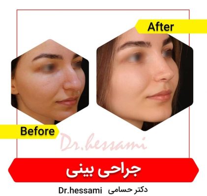 تجميل الأنف في إيران