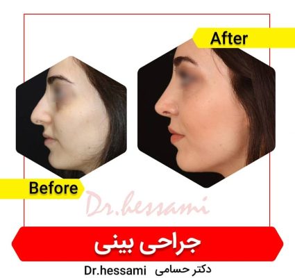 تجميل الأنف في إيران