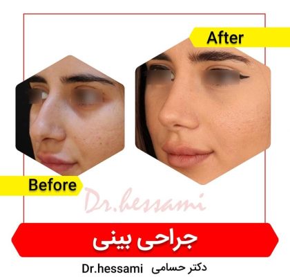 تجميل الأنف في إيران