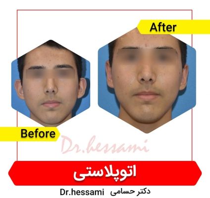 جراحة تجميل الأذن في إيران