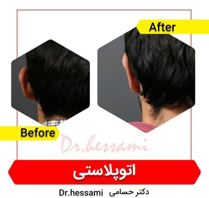 جراحة تجميل الأذن في إيران