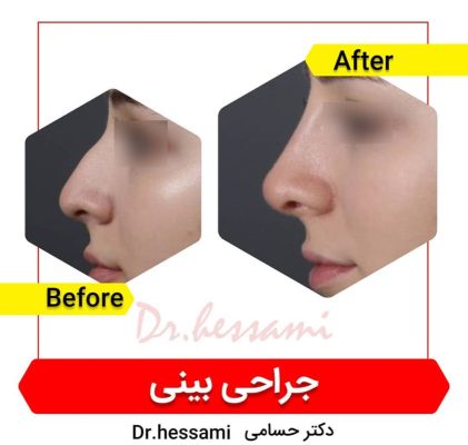 تجميل الأنف في إيران