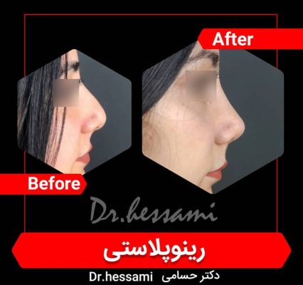 تجميل الأنف في إيران