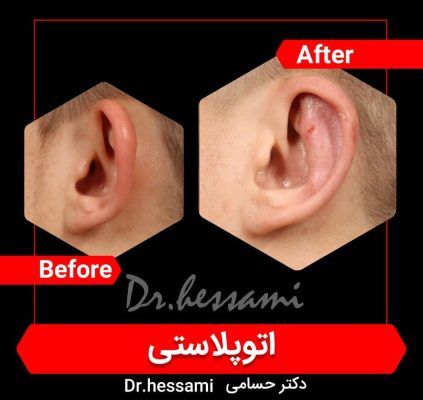 جراحة تجميل الأذن في إيران