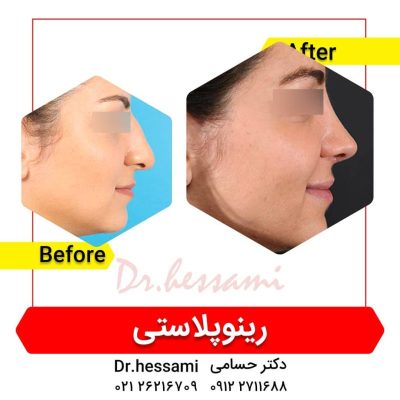 تجميل الأنف في إيران