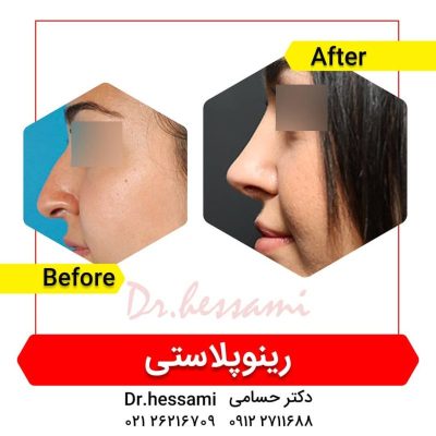 تجميل الأنف في إيران