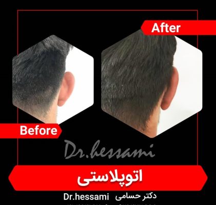 جراحة تجميل الأذن في إيران