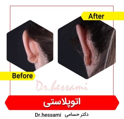 جراحة تجميل الأذن في إيران