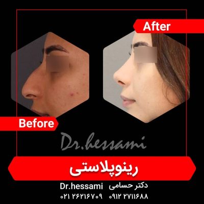 تجميل الأنف في إيران