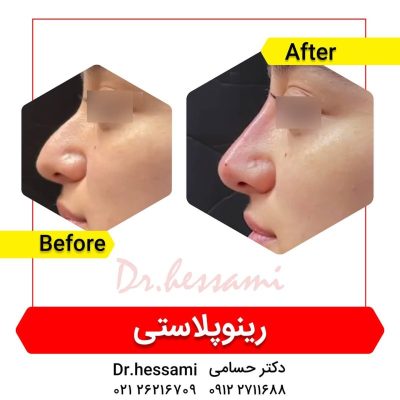 تجميل الأنف في إيران