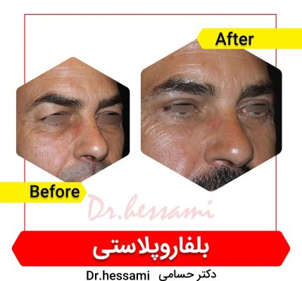 قبل وبعد جراحة الجفن في إيران - جراحة الجفن