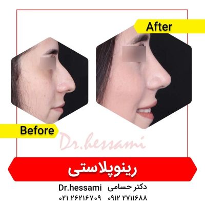 تجميل الأنف في إيران