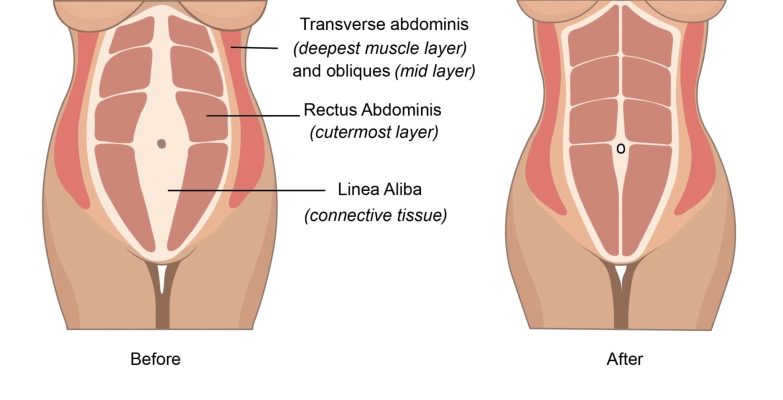 عملية تجميل البطن في إيران