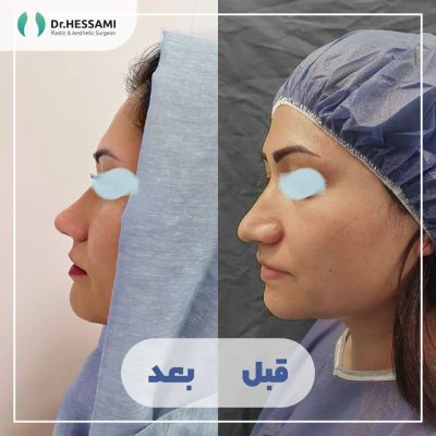 تجميل الأنف في إيران