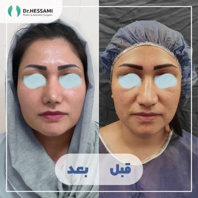 تجميل الأنف في إيران