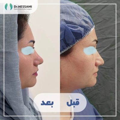 تجميل الأنف في إيران