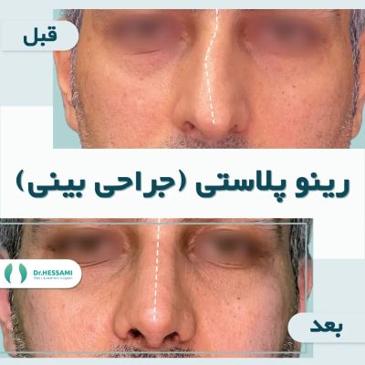 تجميل الأنف في إيران