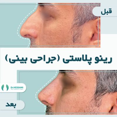 تجميل الأنف في إيران