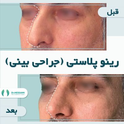 تجميل الأنف في إيران