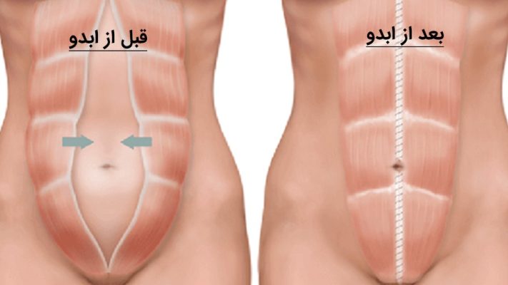 شفط الدهون من البطن في إيران